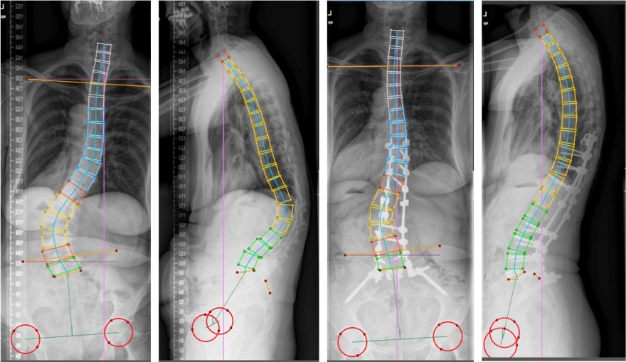 Spinal disorders: lumbar - Neurocirugía Barcelona