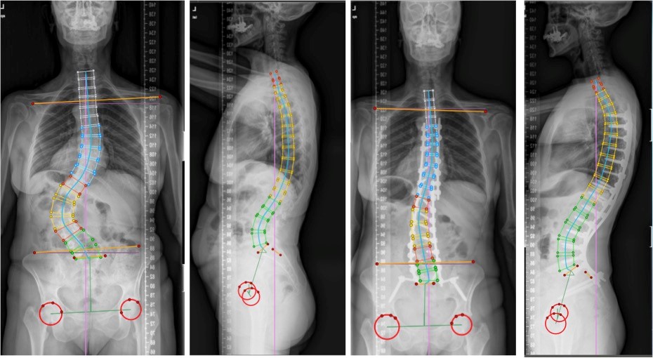 Spinal disorders: lumbar - Neurocirugía Barcelona